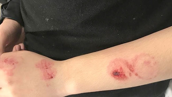 餐厅男服务员胳膊上被咬的牙印 餐厅男服务员胳膊上被咬的牙印