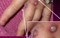 一名感染猴​​​​​痘病毒患者的手（示意图）。（图片来源：Getty Images）