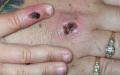 感染猴痘患者的手部。（图片来源：Getty Images）