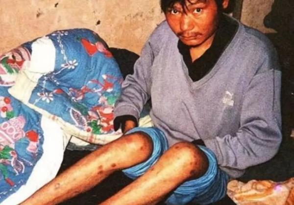 这名29岁的男子因为卖血感染了艾滋病毒。他从16岁开始卖血攒钱，为家里盖房子（图片来源：网络）