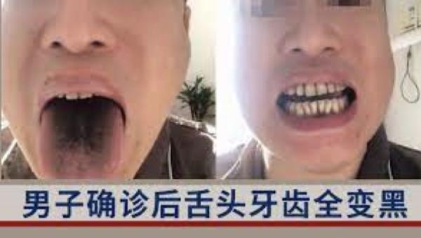 微博上，有人惊爆染疫后出现舌头发黑。（图片来源：视频截图）