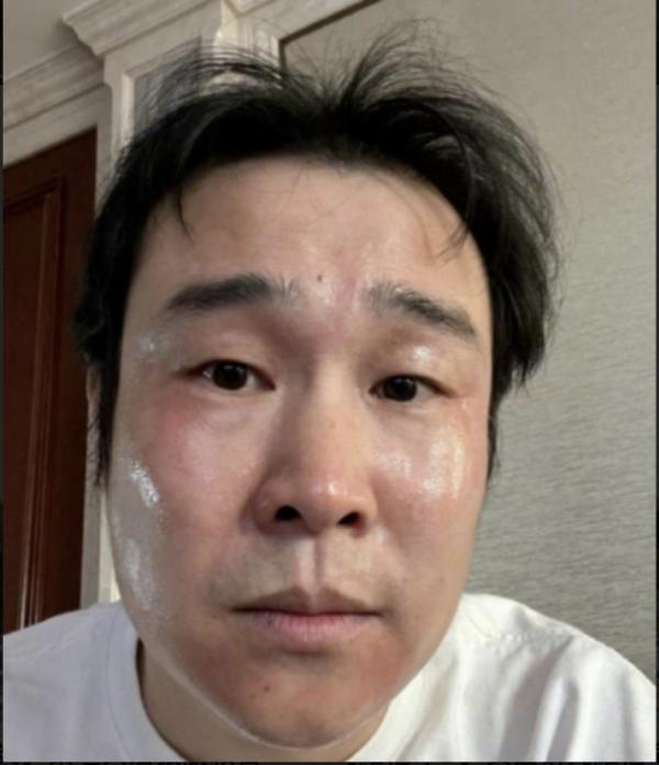 中国演员“小沈阳”早前亦自爆感染新冠，最大的不良反应是面部过敏。（图片来源：微博截图）