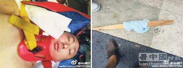 被打的姚先生颈部带着颈椎固定器