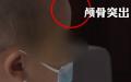 湖南郴州永兴县不少过敏儿的家长发现，自己的孩子最近不停拍且体重骤降， 头骨变成畸形的大头娃娃。（图片来源：视频截图）