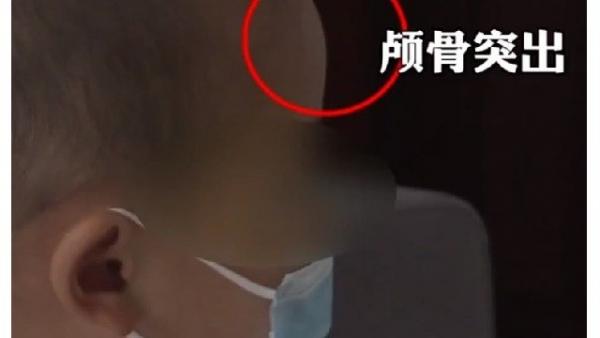湖南郴州永兴县不少过敏儿的家长发现,自己的孩子最近不停拍且体重骤降, 头骨变成畸形的大头娃娃。(图片来源:视频截图)