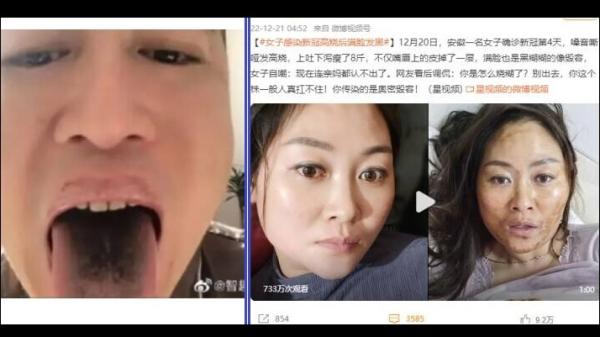天津男子确诊后,发现舌头、牙齿都变黑。(左);安徽女子确诊第4天,满脸变得黑糊,如同被毁容(右)。(图片来源:网络图片)