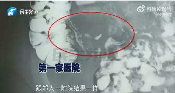 吕先生带儿子去两家医院检查，结果都显示 “ 阑尾可见 ”。（图片来源：视频截图）