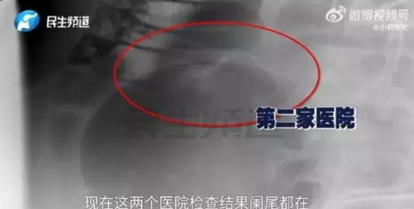吕先生带儿子去两家医院检查，结果都显示“阑尾可见”。（图片来源：视频截图） 【看中国2024年4月8日讯】5年前切除的阑尾如今又长回身体里了？河南许昌吕先生12岁儿2019年右下腹疼痛，医院诊断急性阑尾炎并切除4.5cm阑尾，但术后孩子腹部仍隐隐作痛，2023年9月及今年3月，吕先生分别带儿子前往郑州、上海检查，结果竟然发现阑尾“仍在”，这让全家感到震惊，质疑医院作假或有疏失。相关消息成为7日热搜话题。 《钱江晚报》报导，根据吕先生反映，儿子2019年就诊断出急性阑尾炎，当时手术报告显示阑尾切除术顺利，送检4.5cm阑尾，没想到手术后孩子腹部一直隐隐作痛，直到去年，吕先生带着孩子前往郑州检查，报告显示阑尾显示清晰，对此全家都很震惊，“不是早都切了吗？当时切了什么？孩子几年来一直疼痛，和阑尾炎有关？”  12岁男孩 阑尾炎 吕先生带儿子去两家医院检查，结果都显示“阑尾可见”。（图片来源：视频截图）  对此，先前动手术的长葛人民医院回应，有手术记录，医学影像只是技术，如果有器官套叠就会有这种情况。但吕先生不认可，今年3月带孩子去上海仁济再次检查，仍显示阑尾可见。  根据网络影片显示，一名医院工作人员在回应吕先生及